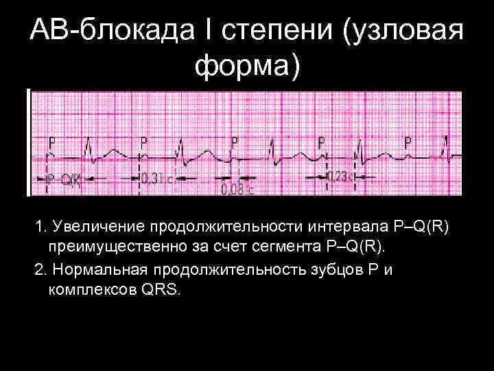 АВ-блокада I степени (узловая форма) 1. Увеличение продолжительности интервала P–Q(R) преимущественно за счет сегмента