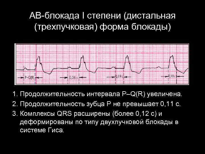 АВ-блокада I степени (дистальная (трехпучковая) форма блокады) 1. Продолжительность интервала P–Q(R) увеличена. 2. Продолжительность