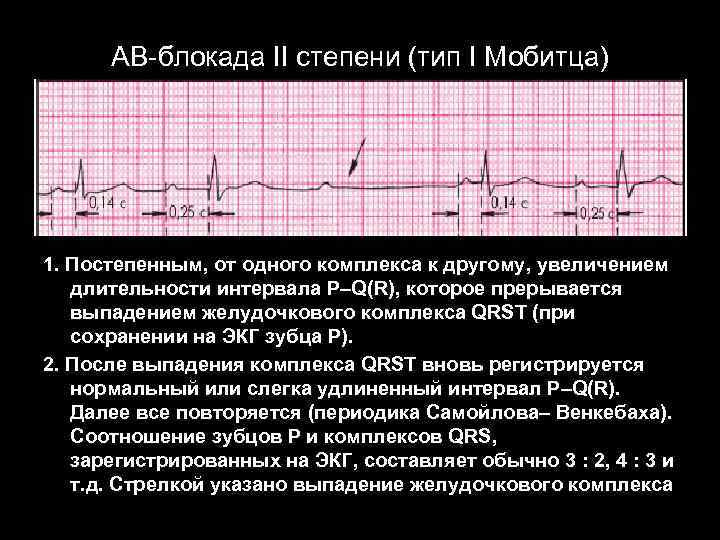 АВ-блокада II степени (тип I Мобитца) 1. Постепенным, от одного комплекса к другому, увеличением