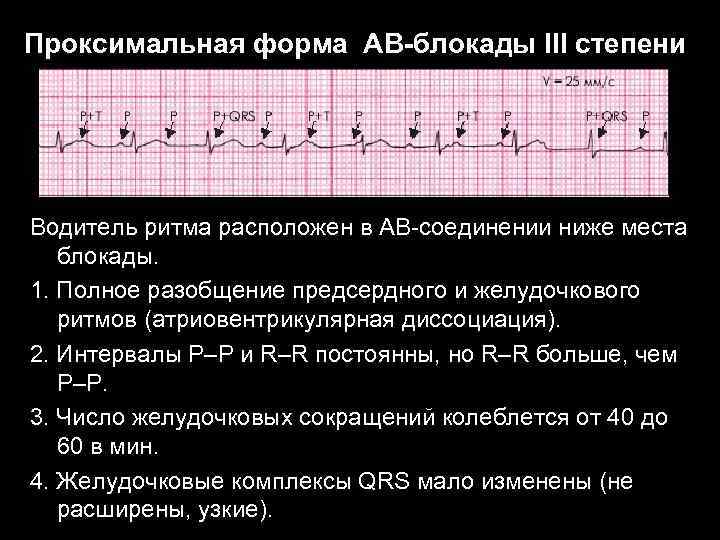 Проксимальная форма АВ-блокады III степени Водитель ритма расположен в АВ-соединении ниже места блокады. 1.