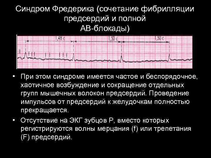 Синдром Фредерика (сочетание фибрилляции предсердий и полной АВ-блокады) • При этом синдроме имеется частое