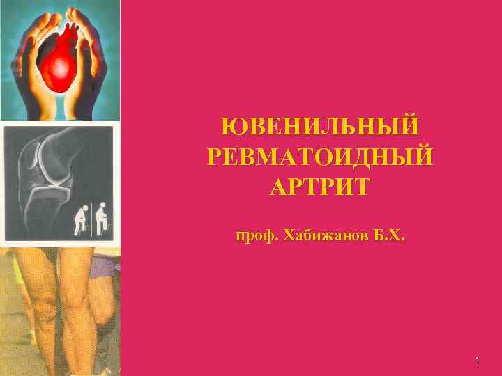 ЮВЕНИЛЬНЫЙ РЕВМАТОИДНЫЙ АРТРИТ проф. Хабижанов Б. Х. 1 