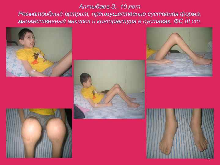 Алтыбаев З. , 10 лет Ревматоидный артрит, преимущественно суставная форма, множественный анкилоз и контрактура
