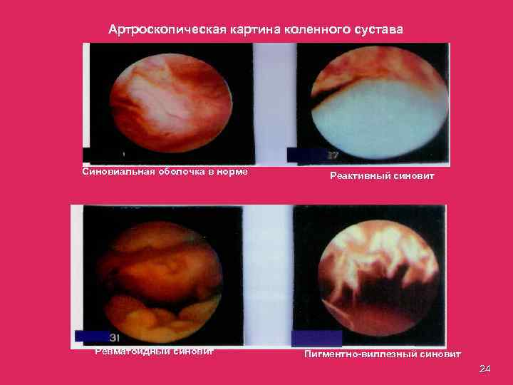 Артроскопическая картина коленного сустава Синовиальная оболочка в норме Ревматоидный синовит Реактивный синовит Пигментно-виллезный синовит