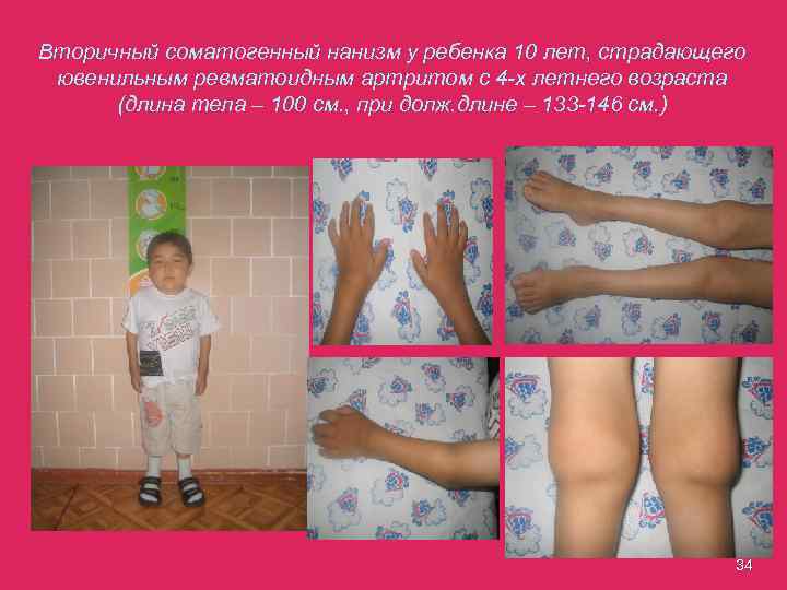 Вторичный соматогенный нанизм у ребенка 10 лет, страдающего ювенильным ревматоидным артритом с 4 -х
