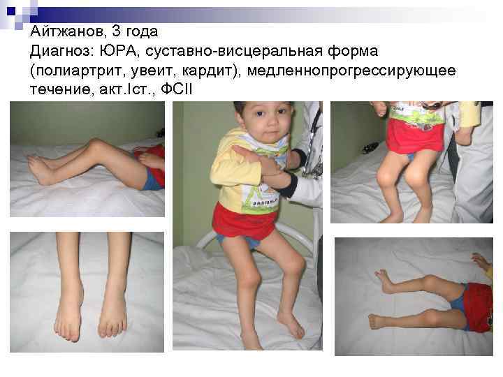 Айтжанов, 3 года Диагноз: ЮРА, суставно-висцеральная форма (полиартрит, увеит, кардит), медленнопрогрессирующее течение, акт. Iст.