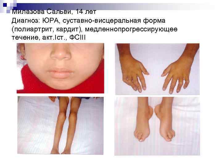 Милазова Сальви, 14 лет Диагноз: ЮРА, суставно-висцеральная форма (полиартрит, кардит), медленнопрогрессирующее течение, акт. Iст.