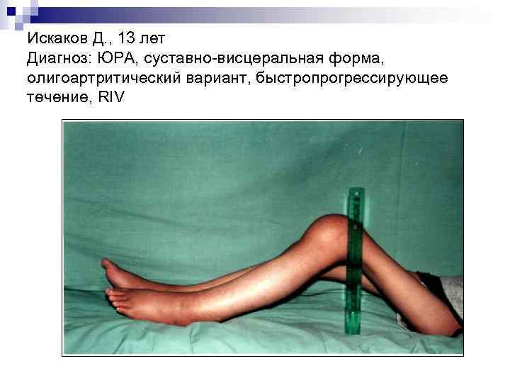 Искаков Д. , 13 лет Диагноз: ЮРА, суставно-висцеральная форма, олигоартритический вариант, быстропрогрессирующее течение, RIV