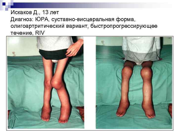 Искаков Д. , 13 лет Диагноз: ЮРА, суставно-висцеральная форма, олигоартритический вариант, быстропрогрессирующее течение, RIV