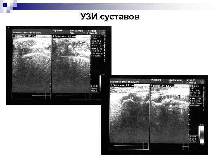 УЗИ суставов 