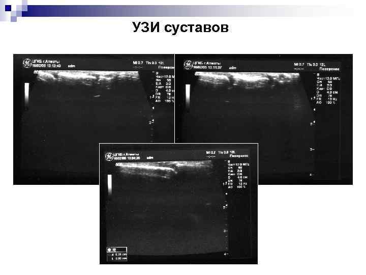 УЗИ суставов 
