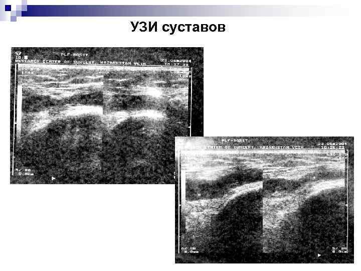 УЗИ суставов 
