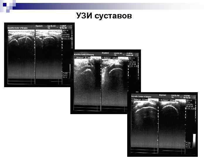 УЗИ суставов 