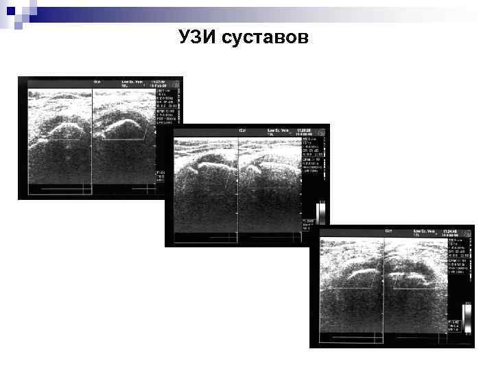 УЗИ суставов 