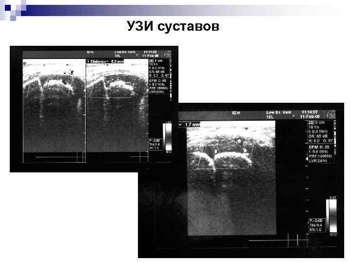 УЗИ суставов 