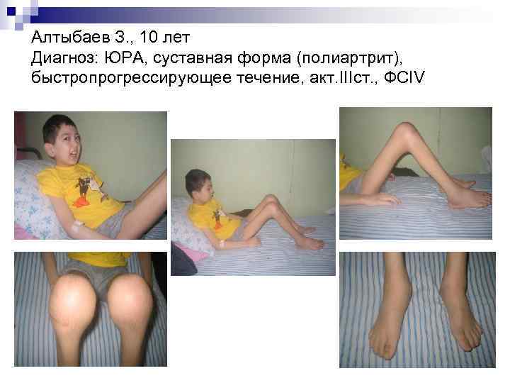 Алтыбаев З. , 10 лет Диагноз: ЮРА, суставная форма (полиартрит), быстропрогрессирующее течение, акт. IIIст.