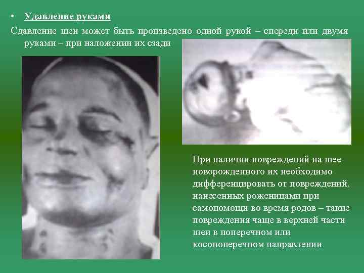  • Удавление руками Сдавление шеи может быть произведено одной рукой – спереди или