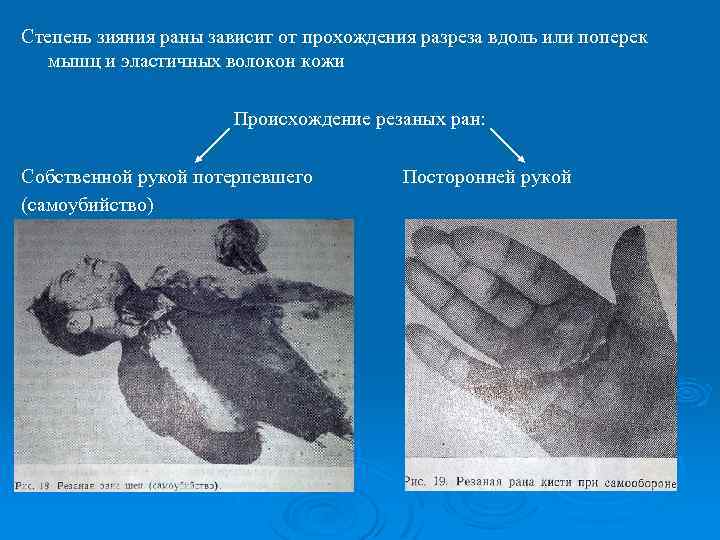 Степень зияния раны зависит от прохождения разреза вдоль или поперек мышц и эластичных волокон