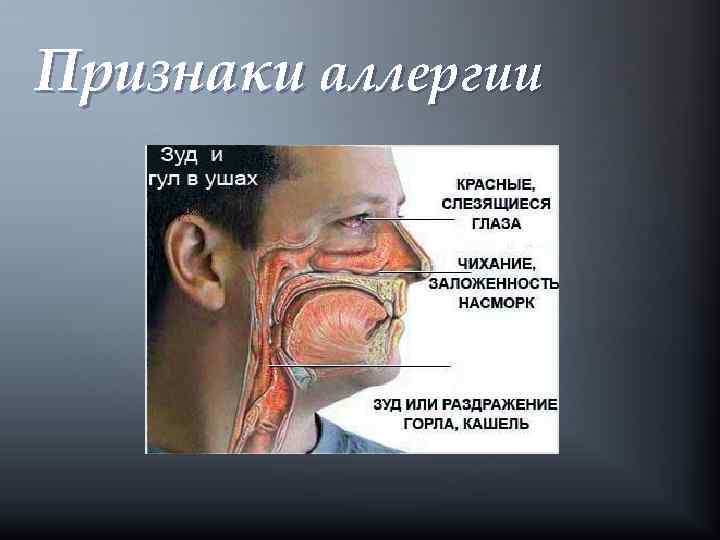 Признаки аллергии 