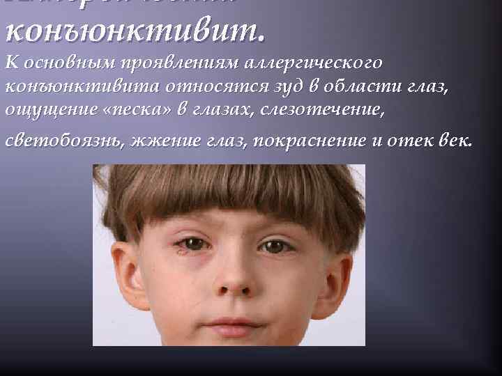 Аллергический конъюнктивит. К основным проявлениям аллергического конъюнктивита относятся зуд в области глаз, ощущение «песка»
