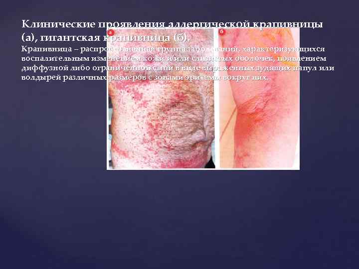 Клинические проявления аллергической крапивницы (а), гигантская крапивница (б). Крапивница – распространенная группа заболеваний, характеризующихся