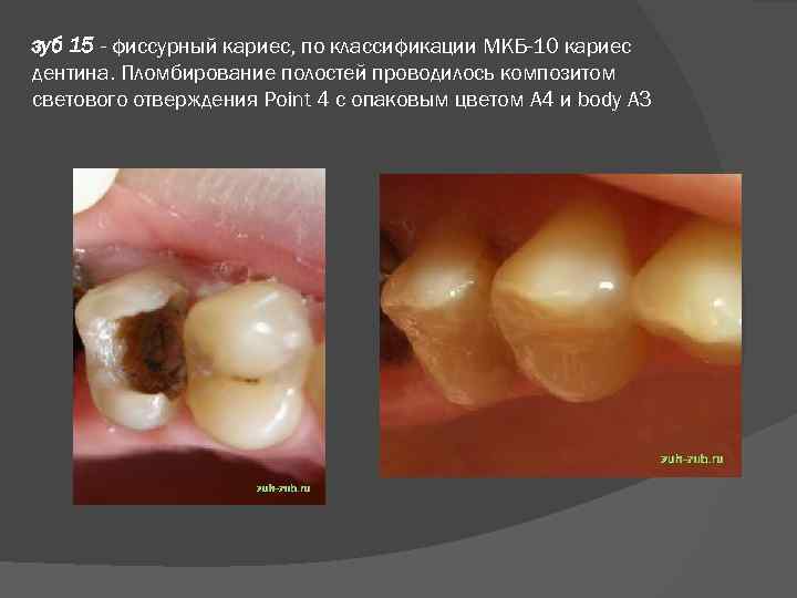 зуб 15 - фиссурный кариес, по классификации МКБ-10 кариес дентина. Пломбирование полостей проводилось композитом
