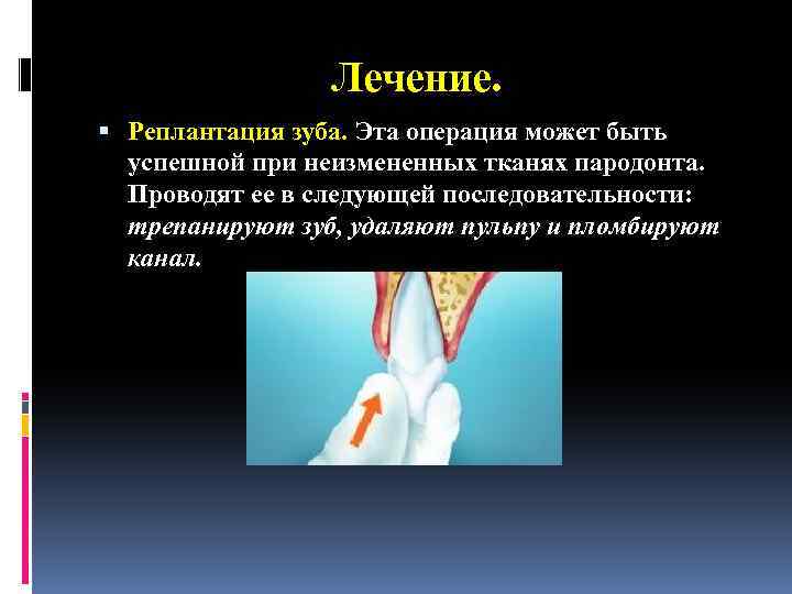 Лечение. Реплантация зуба. Эта операция может быть успешной при неизмененных тканях пародонта. Проводят ее