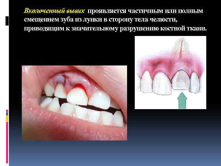 Вколоченный вывих проявляется частичным или полным смещением зуба из лунки в сторону тела челюсти,