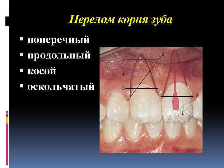 Перелом корня зуба поперечный продольный косой оскольчатый 