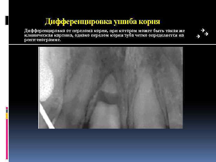 Дифференцировка ушиба корня Дифференцировка от перелома корня, при котором может быть такая же клиническая