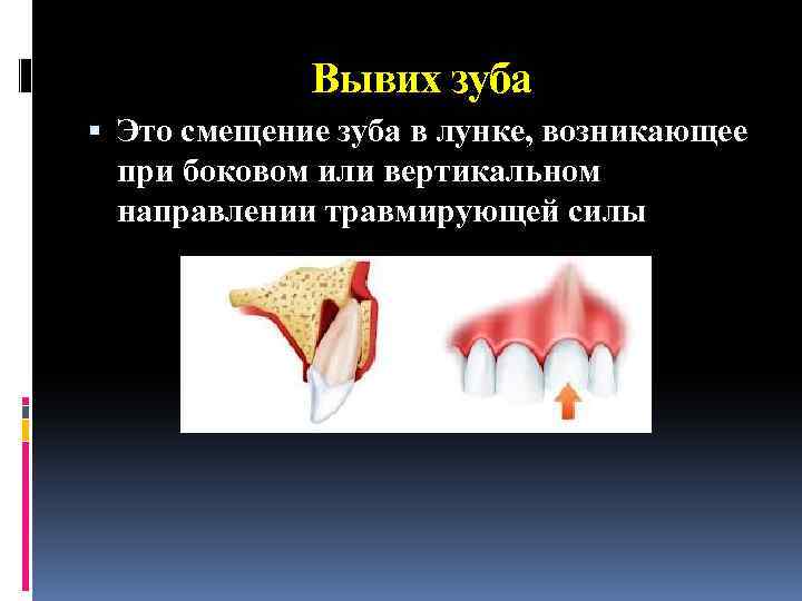 Вывих зуба Это смещение зуба в лунке, возникающее при боковом или вертикальном направлении травмирующей