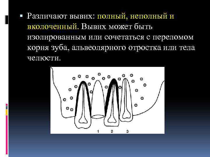  Различают вывих: полный, неполный и вколоченный. Вывих может быть изолированным или сочетаться с