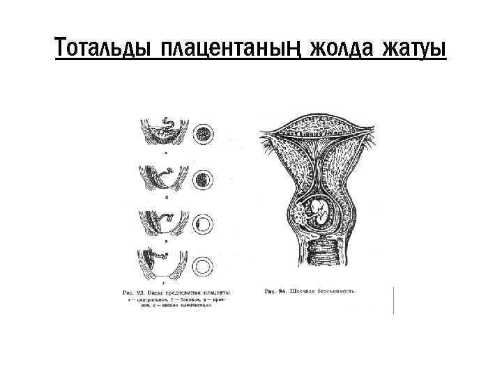 Тотальды плацентаның жолда жатуы 