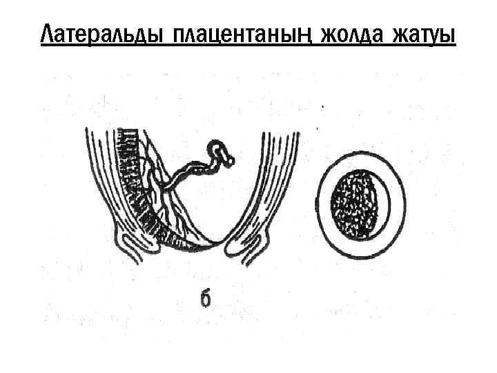 Латеральды плацентаның жолда жатуы 