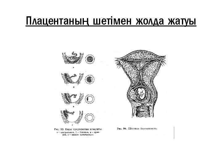 Плацентаның шетімен жолда жатуы 