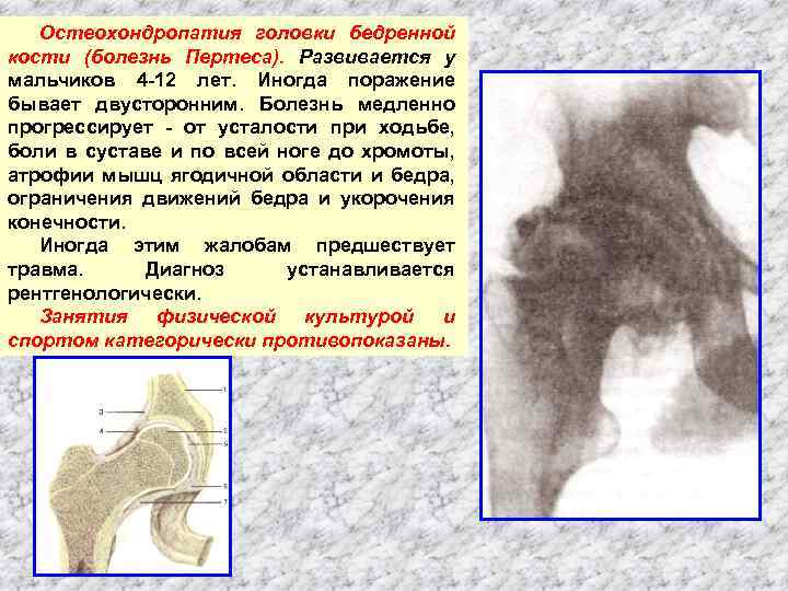 Остеохондропатия головки бедренной кости (болезнь Пертеса). Развивается у мальчиков 4 12 лет. Иногда поражение