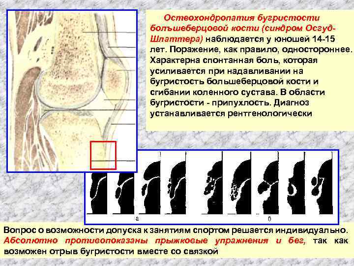 Остеохондропатия бугристости болъшеберцовой кости (синдром Осгуд. Шлаттера) наблюдается у юношей 14 15 лет. Поражение,