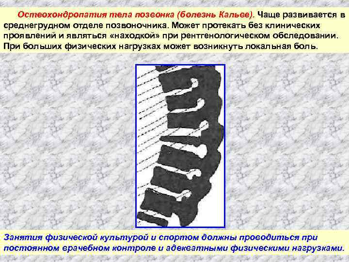 Остеохондропатия тела позвонка (болезнь Кальве). Чаще развивается в среднегрудном отделе позвоночника. Может протекать без