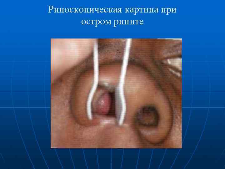 Риноскопическая картина при остром рините 
