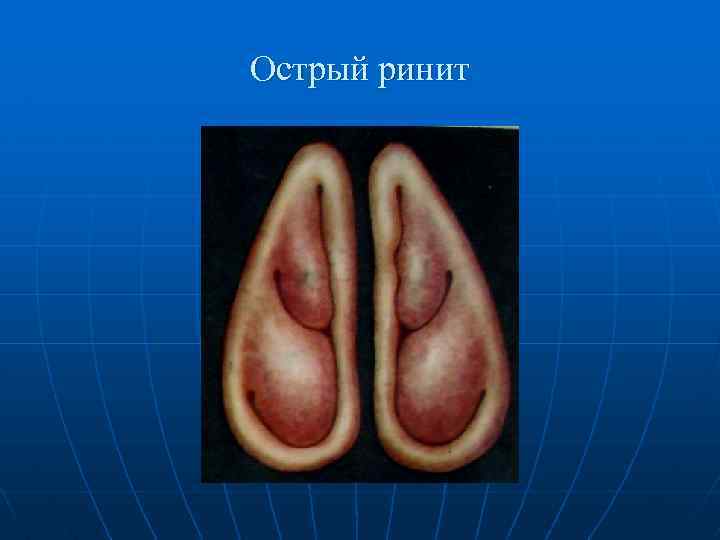 Острый ринит 
