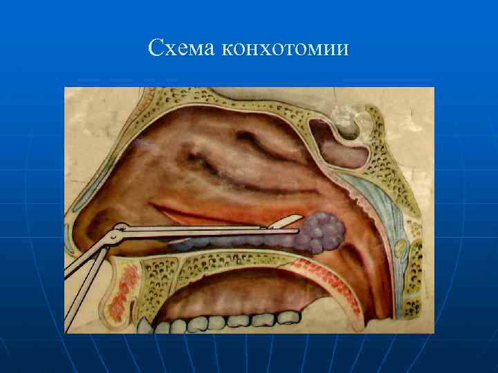 Схема конхотомии 