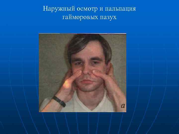 Наружный осмотр и пальпация гайморовых пазух 