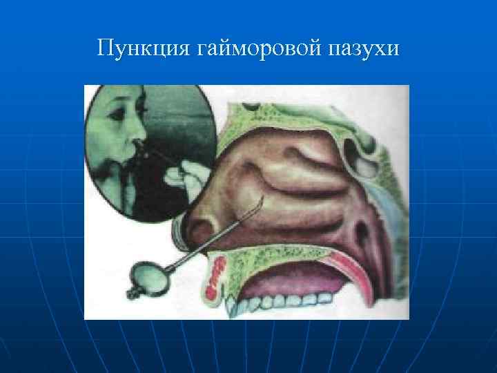 Пункция гайморовой пазухи 