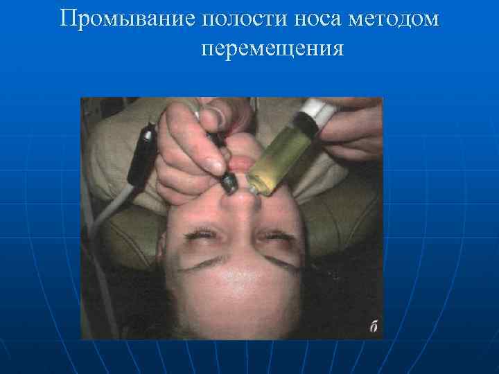 Промывание полости носа методом перемещения 