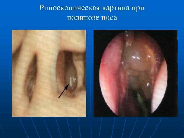 Риноскопическая картина при полипозе носа 