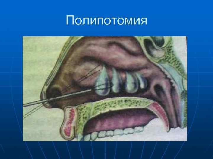 Полипотомия 