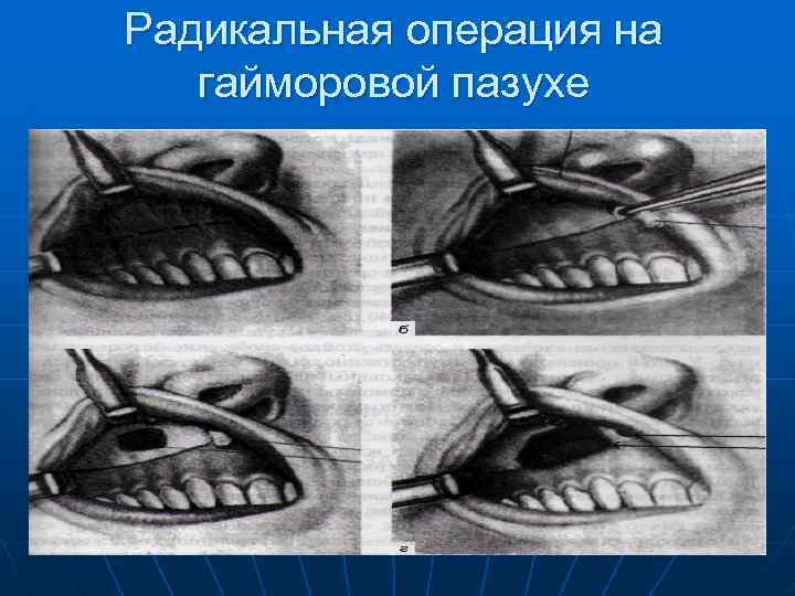 Радикальная операция на гайморовой пазухе 