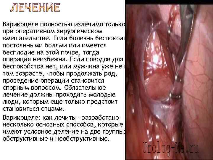  Варикоцеле полностью излечимо только при оперативном хирургическом вмешательстве. Если болезнь беспокоит постоянными болями