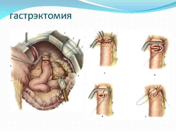 гастрэктомия 