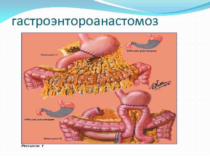 гастроэнтороанастомоз 